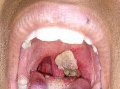 Increased diphtheria cases in Haiti: Health authorities call for vigilance and vaccination